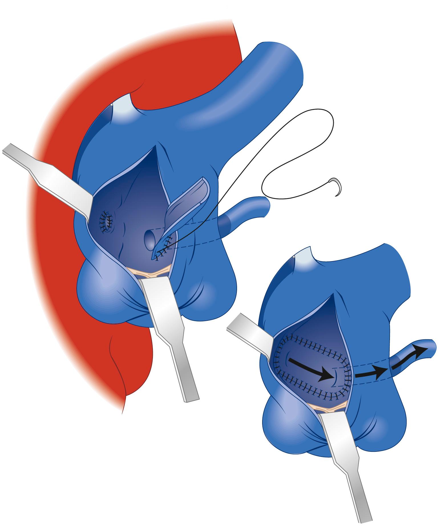 FIGURE 124-9, A segment of 4-mm polytetrafluoroethylene (Gore-Tex) graft is opened longitudinally and used to fashion a baffle that directs blood flow from the aortopulmonary window to the anomalous coronary ostium.