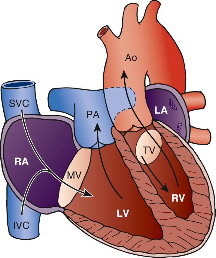 FIGURE 126-1, Diagram of congenitally corrected transposition of the great arteries. Ao, Aorta; IVC, inferior vena cava; LA, left atrium; LV, left ventricle; MV, mitral valve; PA, pulmonary artery; RA, right atrium; RV, right ventricle; SVC, superior vena cava; TV, tricuspid valve.