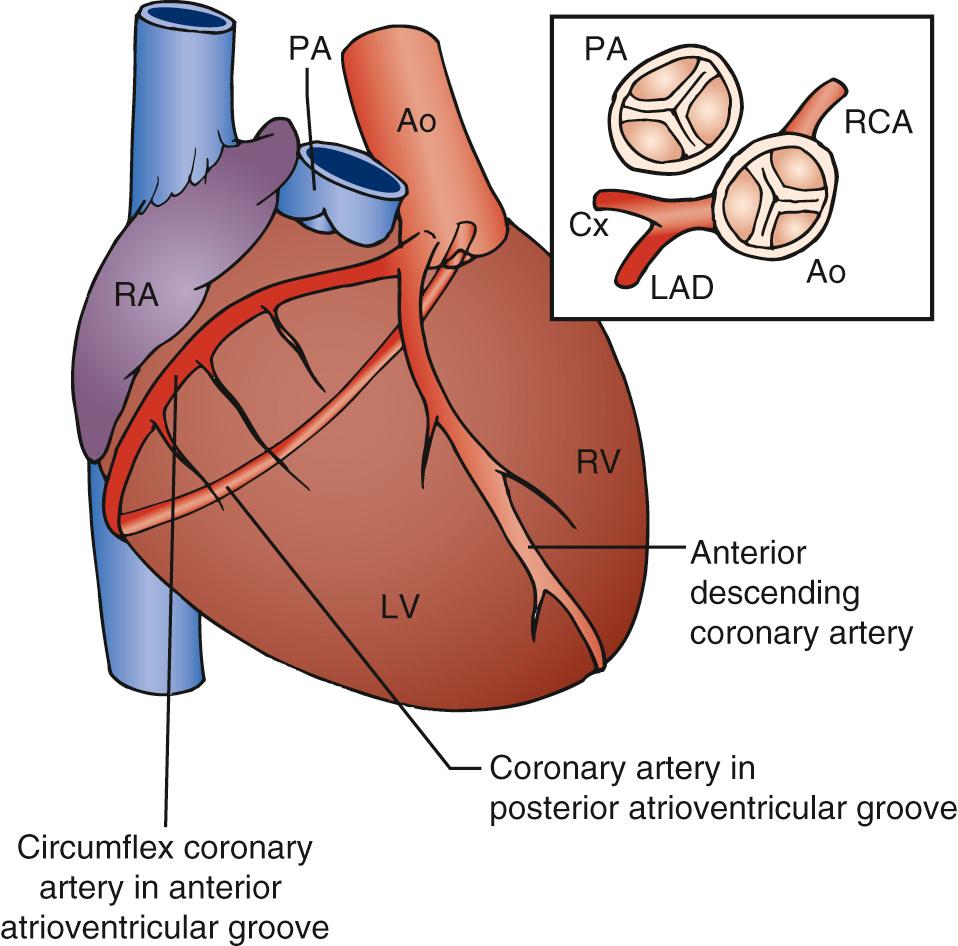 FIGURE 126-2, Disposition of coronary arteries in congenitally corrected transposition of the great arteries. Ao, Aorta; Cx, circumflex coronary artery; LAD, left anterior descending coronary artery; LV, left ventricle; PA, pulmonary artery; RA, right atrium; RCA, right coronary artery; RV, right ventricle.