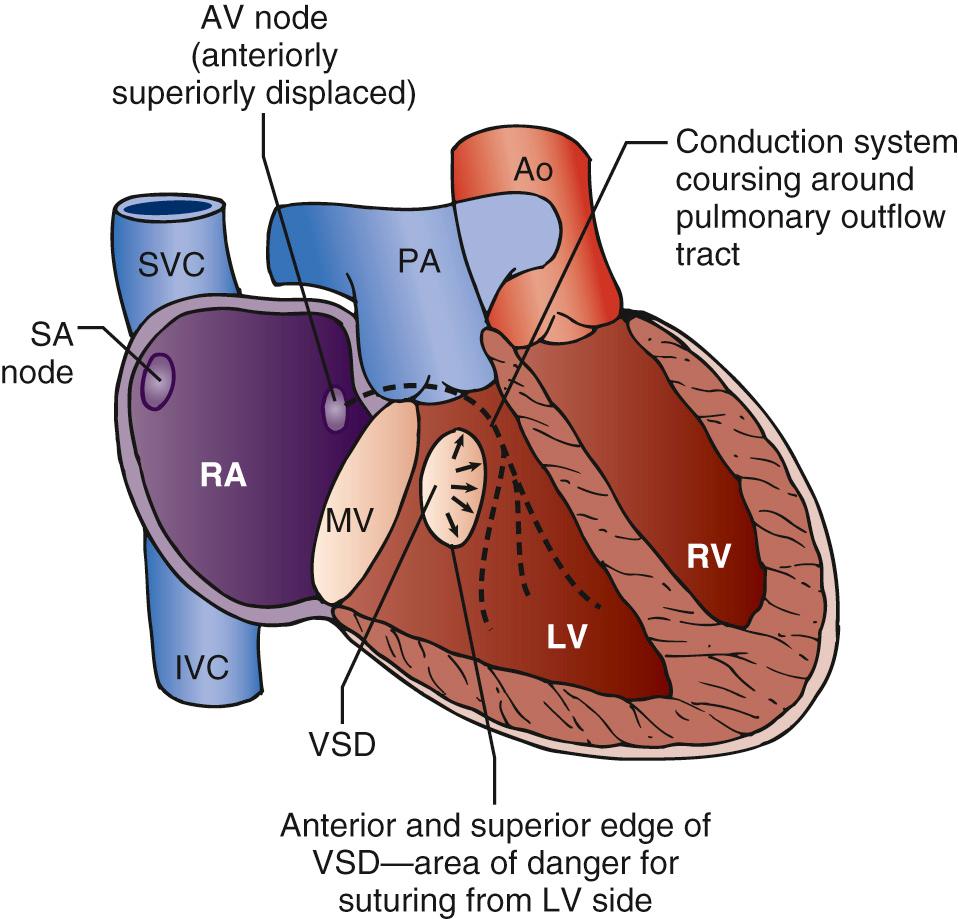 FIGURE 126-3, Disposition of conduction system in congenitally corrected transposition of the great arteries and relationship to ventricular septal defect (VSD). Ao, Aorta; AV node, atrioventricular node; IVC, inferior vena cava; LV, left ventricle; MV, mitral valve; PA, pulmonary artery; RA, right atrium; RV, right ventricle; SA node, sinus atrial node; SVC, superior vena cava.