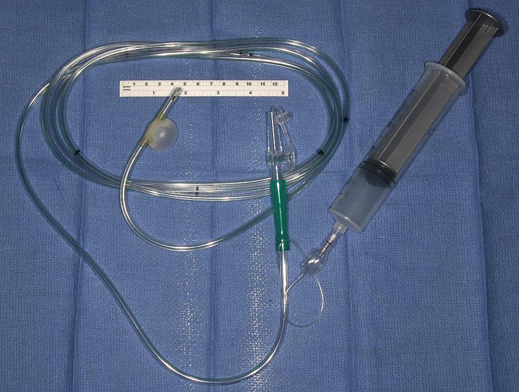 FIGURE 163.1, The Baker tube used to help to identify areas of small bowel strictures not easily identified on inspection and palpation of the bowel. The bowel is inflated with 15 mL of normal saline to achieve a diameter of 1 cm.