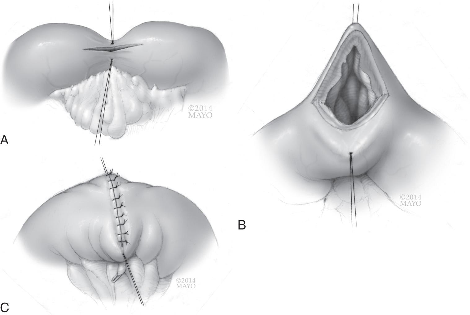 FIGURE 163.2, A Heineke-Mikulicz strictureplasty is performed by opening the small bowel along the antimesenteric border of the stricture and then closed transversely.