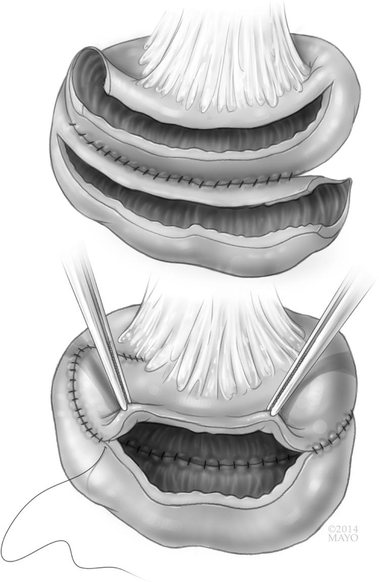 FIGURE 163.3, The isoperistaltic side-to-side strictureplasty is used to treat long strictures or multiple strictures that are very close to one another. The diseased segment is divided in the center of the area and overlapped. The antimesenteric border is opened in both segments and then the divided bowel segments are sutured together to construct a common lumen.