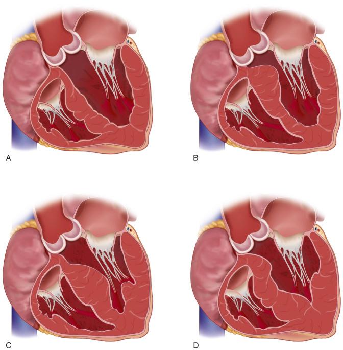 Figure 29.1, Patterns of hypertrophy in patients with hypertrophic cardiomyopathy. (A) Normal ventricular morphology. (B) Basal septal hypertrophy, a pattern that is ideal for septal myectomy. (C) Septal hypertrophy extends from the subaortic area to the midventricle. (D) Apical hypertrophic cardiomyopathy.