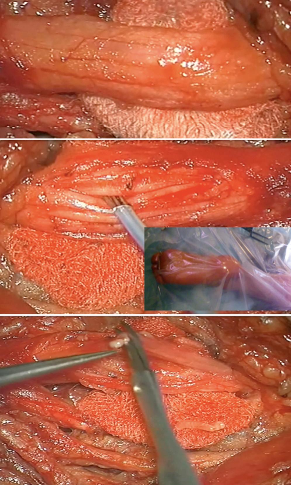 FIGURE 113.5, General principles of peripheral neurotomy. Microsurgical views of steps of neurotomy—at level of the tibial nerve, for toes in claw, as an example. Upper view: distal trunk of the tibial nerve with fascicles enclosed in epineurium. Center: fascicles exposed after opening of epineurium, and individual stimulation with a (tripolar) electrical probe to identify the motor fascicles corresponding to the flexor digitorum muscles. Lower view: sectioning of a selected fascicle among several.