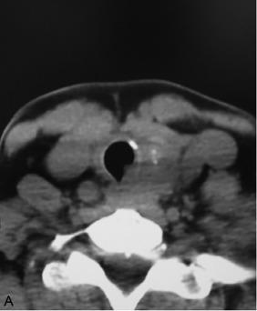 Fig. 37.2, A, Axial computed tomography (CT) showing a left thyroid mass with potential invasion into the tracheal lumen. B, Preoperative tracheoscopy was performed. It showed a submucosal tracheal mass consistent with invasive thyroid cancer.