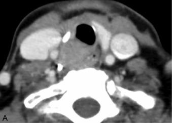 Fig. 37.3, A, Axial computed tomography (CT) showing an invasive malignant paraganglioma, a rare histology invading the laryngotracheal complex necessitating a total laryngectomy. B and C, The laryngectomy specimen, seen in sagittal orientation, demonstrates the invasion of the malignancy through the cricoid and thyroid cartilages.