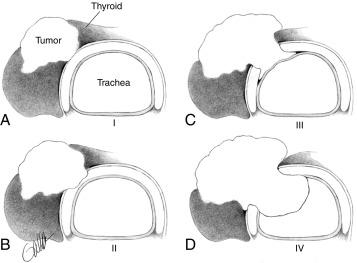 Fig. 37.4, Staging of papillary carcinoma of the thyroid invading the trachea, based on histopathologic extent of the invasion. A, Stage I tumor extends through the capsule of the thyroid gland and abuts external perichondrium but does not erode cartilage or invade between cartilaginous plates. B, Stage II carcinoma invades between rings of cartilage, or it destroys cartilage. C, Stage III carcinoma extends through cartilage or between cartilaginous plates into the lamina propria of tracheal mucosa but does not invade the epithelium. D, Stage IV tumor extends through the entire thickness of and expands tracheal mucosa. This is visible through a bronchoscope as a nodule or ulcerated mass.