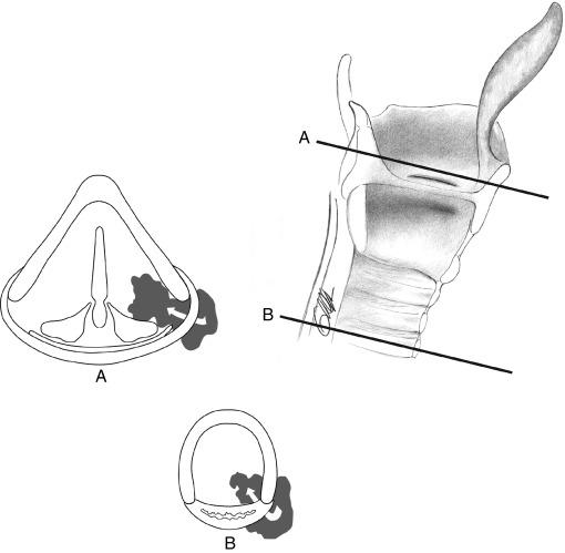 Fig. 37.6, Routes of spread to the laryngotracheal complex by invasive thyroid cancer. A, Spread from the superior pole around the posterior border of the thyroid ala to involve the paraglottic space and encroach on the pyriform sinus. B, Extension through the trachea at the level of the tracheoesophageal groove from a metastatic lymph node. C, Invasion through the thyroid cartilage as well as around the posterior border. D, Anterior tracheal involvement by direct spread from an isthmus tumor. E, Cross-sectional imaging demonstrates involvement of the pyriform sinus by disease extending from the superior pole around the posterior border of the thyroid cartilage.