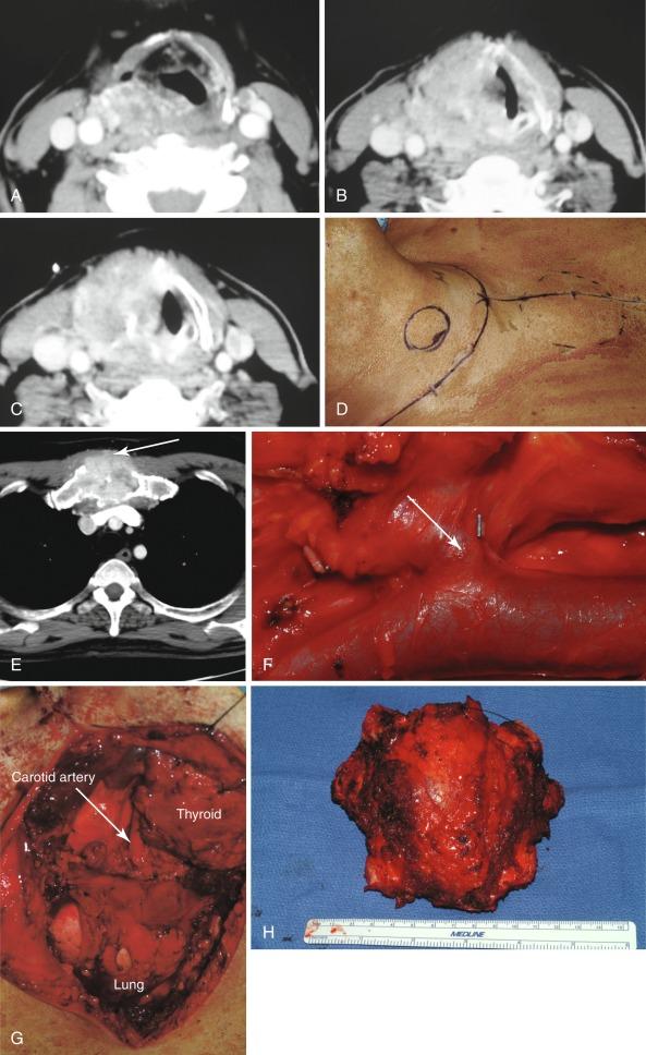Fig. 37.7, A–C, Extensive laryngotracheal invasion by a papillary thyroid cancer that presented with vocal cord paralysis. Various points of entry are demonstrated through the various cross-sectional images. D and E, Resection of the primary tumor as well as a noncontiguous focus of disease involving the manubrium (arrow) was performed through a T-shaped incision that provided access to the laryngotracheal complex and the sternum. F, Tumor thrombus was found in the venous system with intraluminal disease identified at the junction of the superior thyroid vein with the common facial vein (arrow). G and H, Following resection of the manubrium (H) , the mediastinal contents and the carotid artery were identified along with the invasive thyroid cancer. I, The total laryngectomy specimen is demonstrated with a segment of the internal jugular vein (arrow). J, The intraluminal thrombus in the internal jugular vein is demonstrated (arrow). K, Closure of the pharyngotomy is demonstrated with a linear closure (arrow). L, Pectoralis major musculocutaneous flap (arrow) was harvested to provide an augmented closure of the mediastinum and the pharyngeal suture line. The pectoralis skin was used to restore the inferior portion of the laryngostoma. M, Cross sections through the larynx and trachea of this patient following a total laryngectomy demonstrate the pathways for entry into the laryngotracheal complex. N, Invasion through the lateral wall of the trachea. O, Invasion through and around the posterior border of the thyroid cartilage to involve the cricoid and paraglottic space.