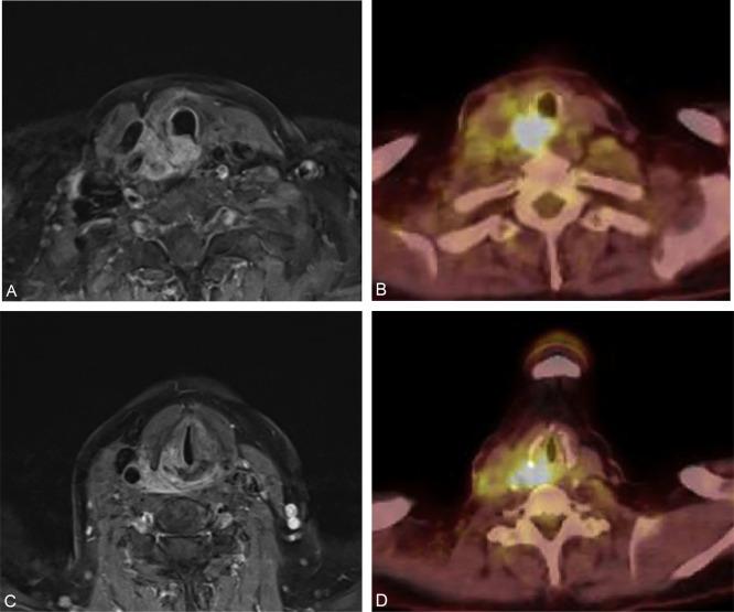 Fig. 37.8, Postcontrast T1-weighted magnetic resonance imaging (MRI) and positron emission tomography and computed tomography (PET/CT) scan of an aggressive papillary thyroid carcinoma recurrence invading the tracheoesophageal party wall (A and B) with intraluminal extension into both the trachea and the esophagus, superior extension through the cricothyroid articulation and into the right true vocal fold (C and D) , and lateral extension into the adventitia of the common carotid artery.