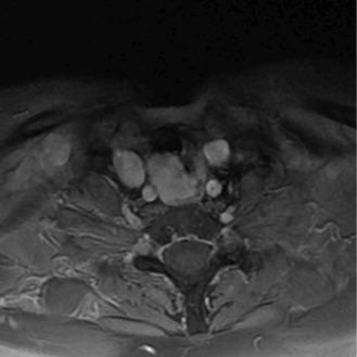 Fig. 37.9, Postcontrast T1-weighted magnetic resonance imaging (MRI) showing recurrent papillary thyroid carcinoma invading the tracheoesophageal party wall. The etiology of this recurrence was presumed to be from residual disease left in the tracheoesophageal groove near the recurrent laryngeal nerve (RLN).