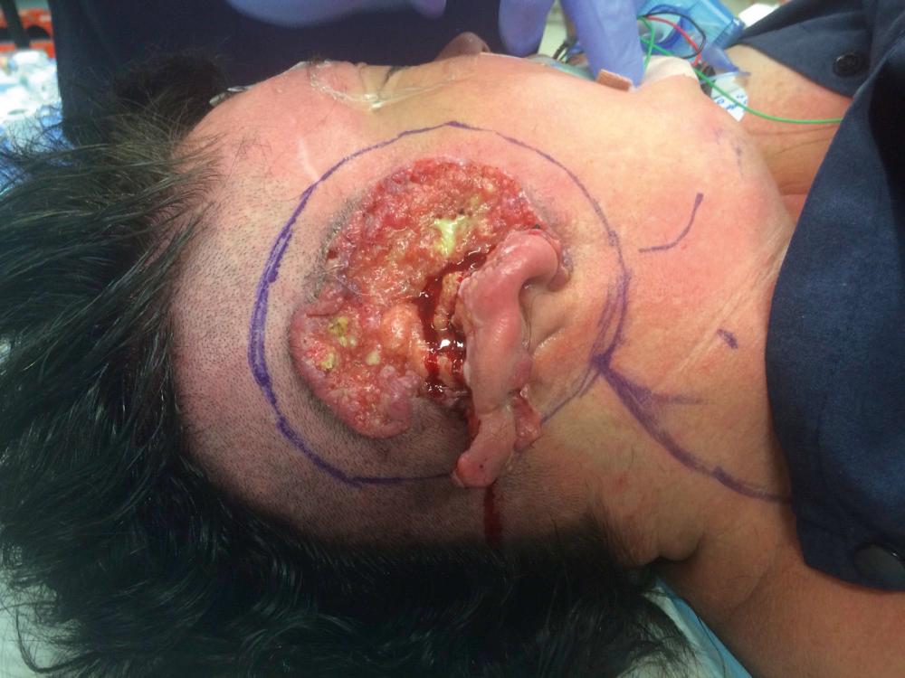 Fig. 49.1, Basal cell carcinoma (BCC) invading bone.