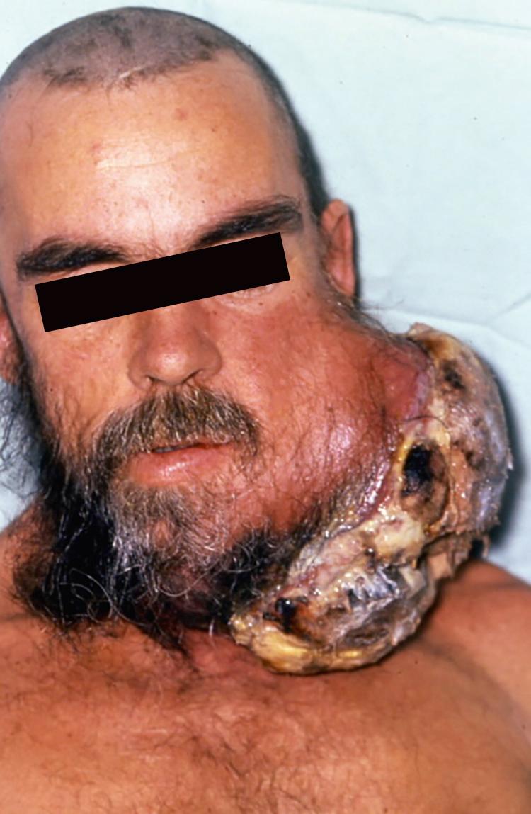 Fig. 49.2, Metastatic melanoma with distant disease treated with palliative resection and regional pectorals flap reconstruction for symptom relief.