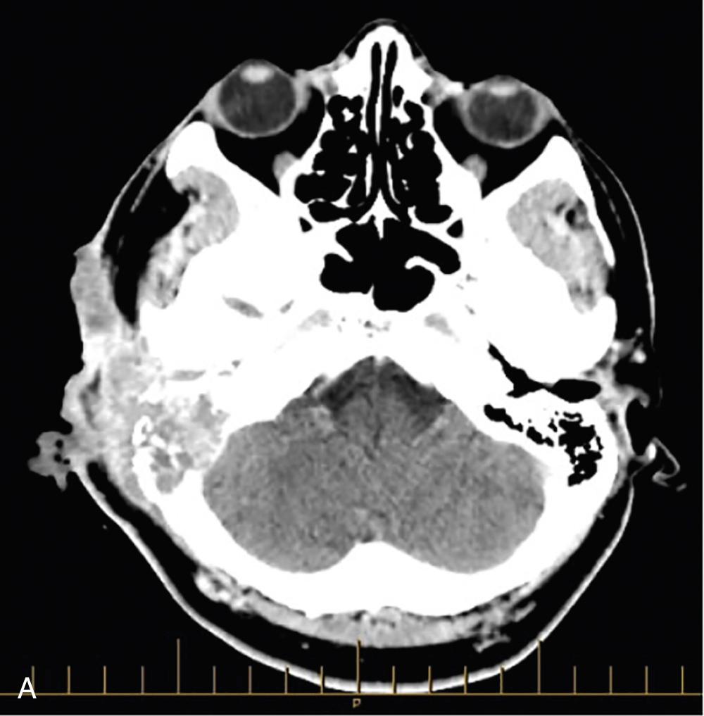 Fig. 49.3, (A) CT scan of BCC invading bone. (B) Intraoperative image of a superficial parotidectomy and selective neck dissection for metastatic cutaneous SCC.