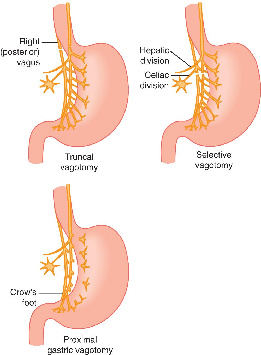 FIGURE 59.1, Schematic representation of the three standard forms of vagotomy.