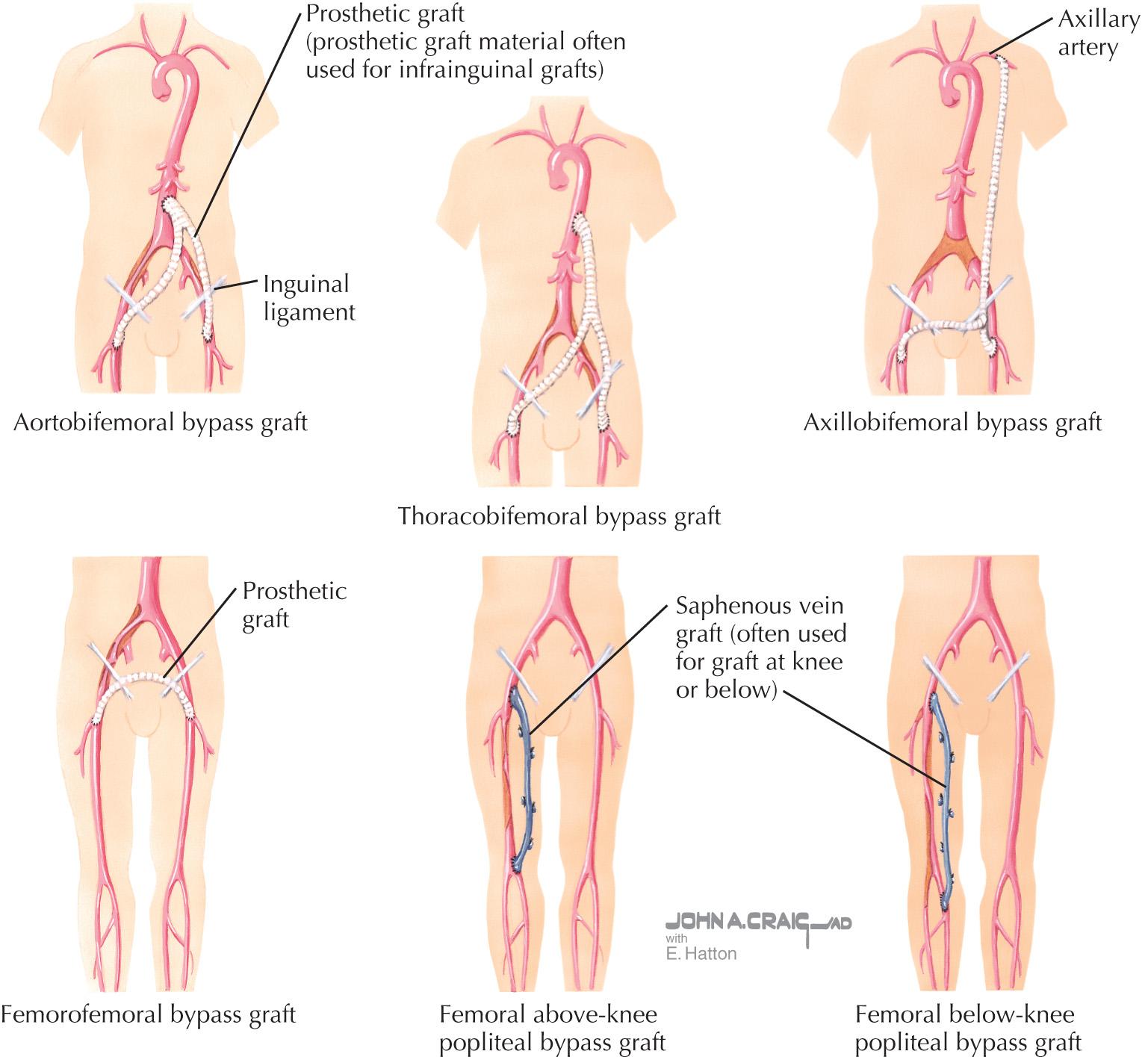 FIG 60.3, Surgical Management of Peripheral Arterial Disease of the Lower Extremities.