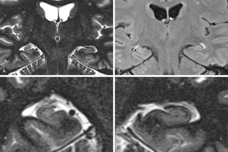 Figure 55.1, High-resolution MRI showing mesial temporal sclerosis. T2-IR (inversion recovery) sequence showing decreased size of the right hippocampus (A). FLAIR imaging also often shows increased signal on the sclerotic side (B). Note also the disruption of the normal hippocampal architecture on the right (C) when compared with the left side (D).