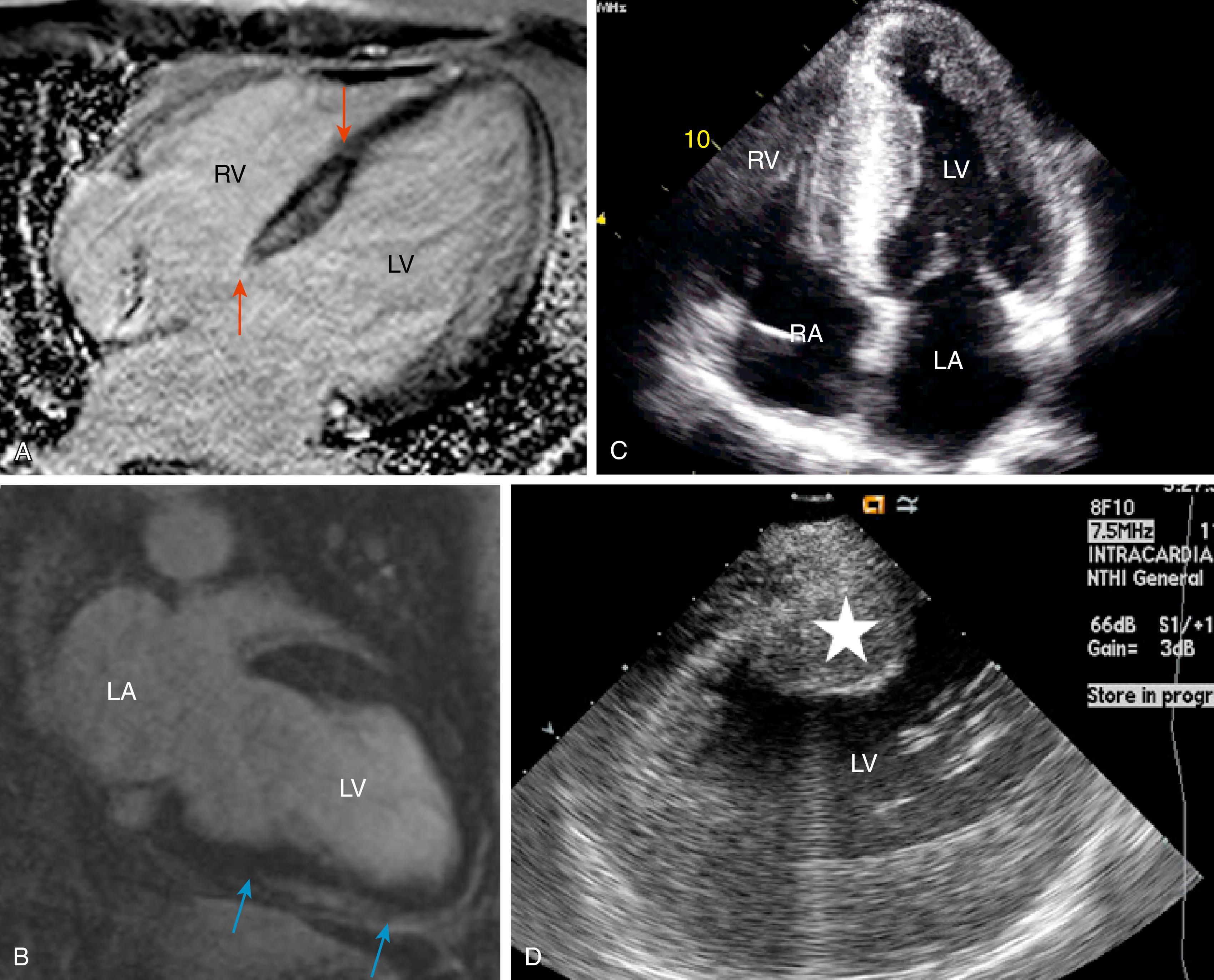 Fig. 136.1, Septal scar identified by magnetic resonance imaging (MRI) and echocardiographic imaging.