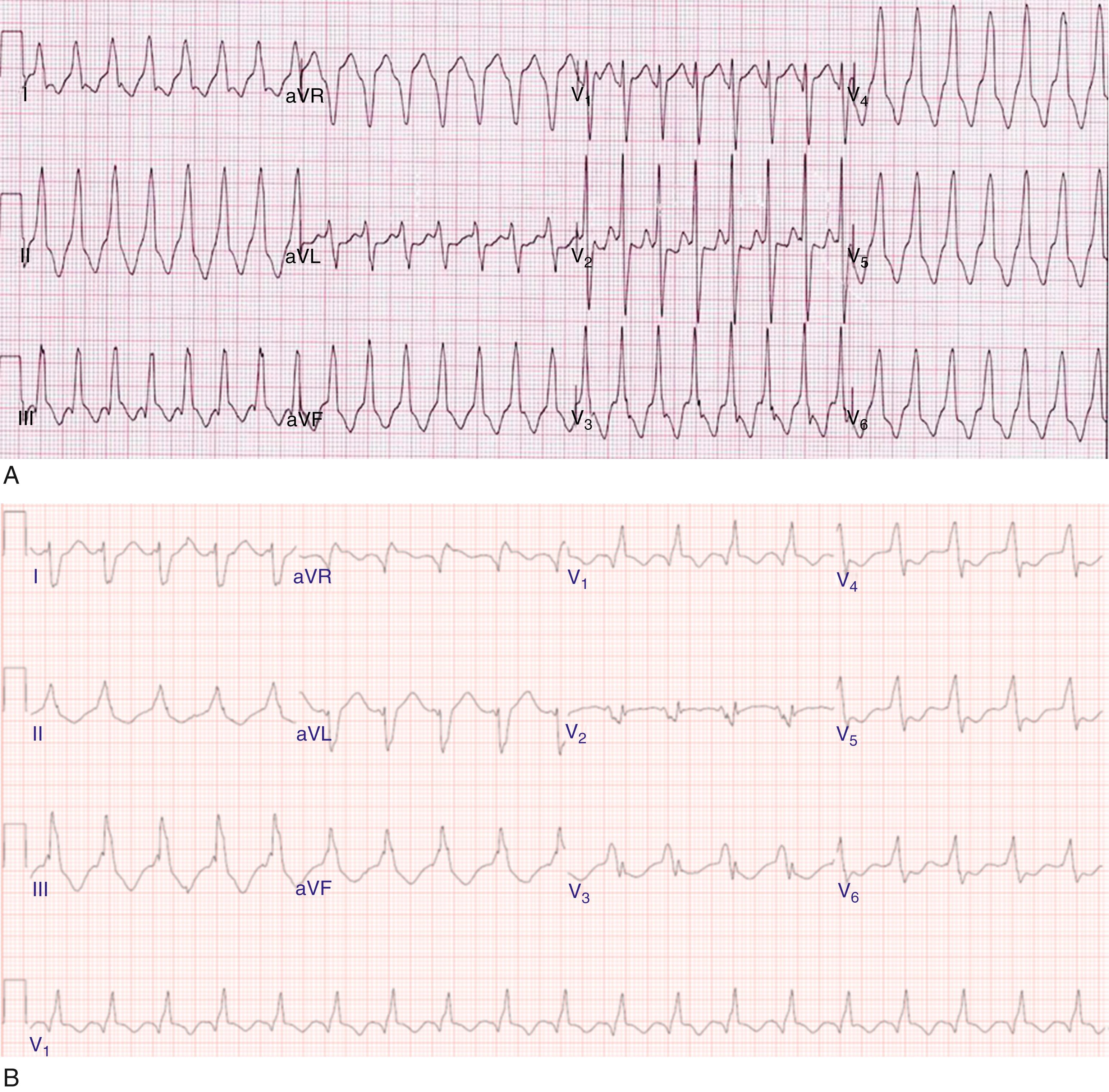 Fig. 136.2, (A) A 12-lead electrocardiogram (ECG) of ventricular tachycardia (VT) manifesting a left bundle branch block morphology and inferior axis with early transition (≤V 3 ). (B) A 12-lead ECG of VT manifesting a right bundle branch block morphology, inferior axis, and unusual transition pattern (predominantly positive forces in leads V 1 and V 3 –V 6 but negative forces in lead V 2 ). These features are characteristic of VT originating from the interventricular septal region.