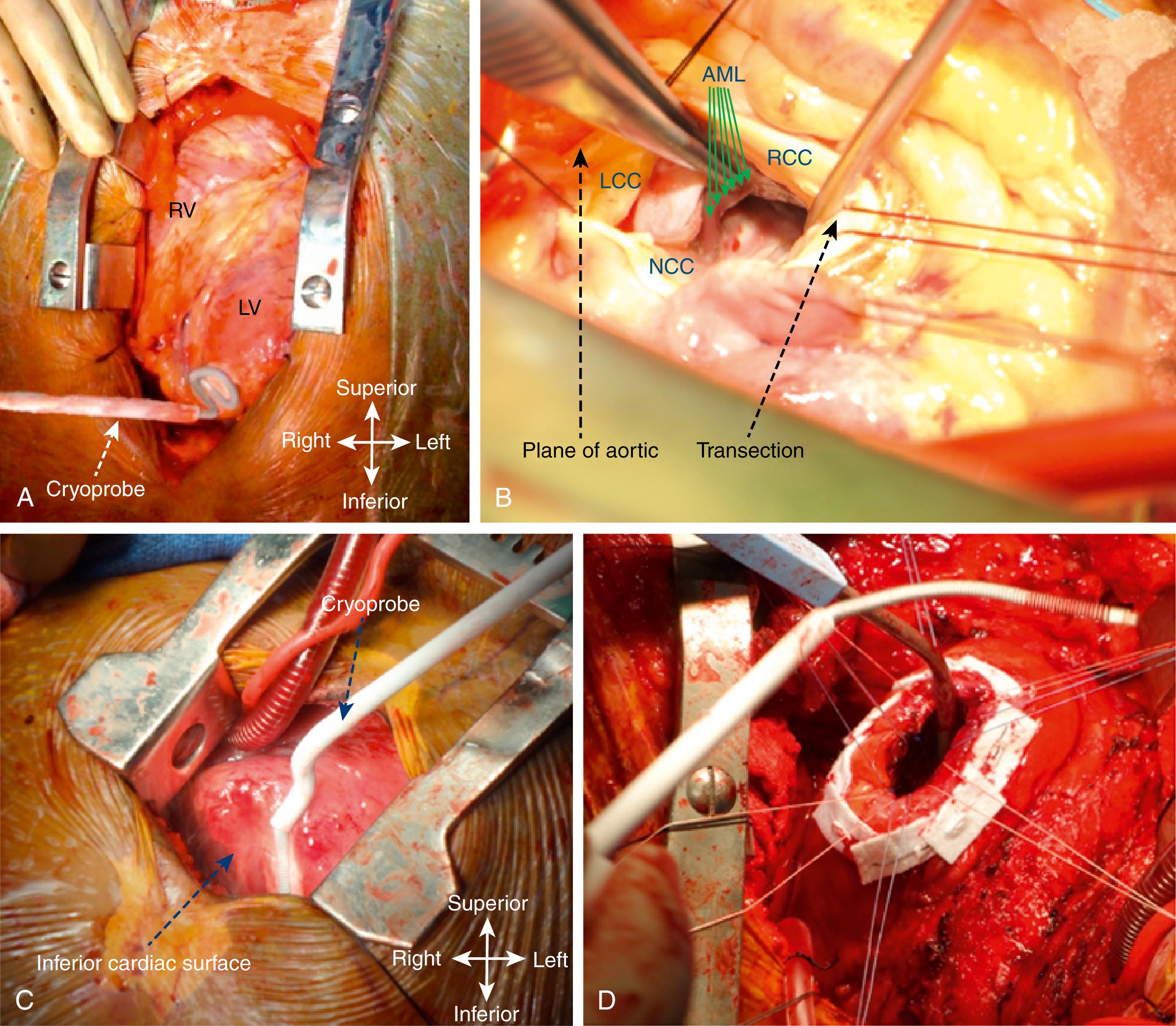 Fig. 136.3, Examples of different techniques to expose various cardiac surfaces during surgical ventricular tachycardia ablation.