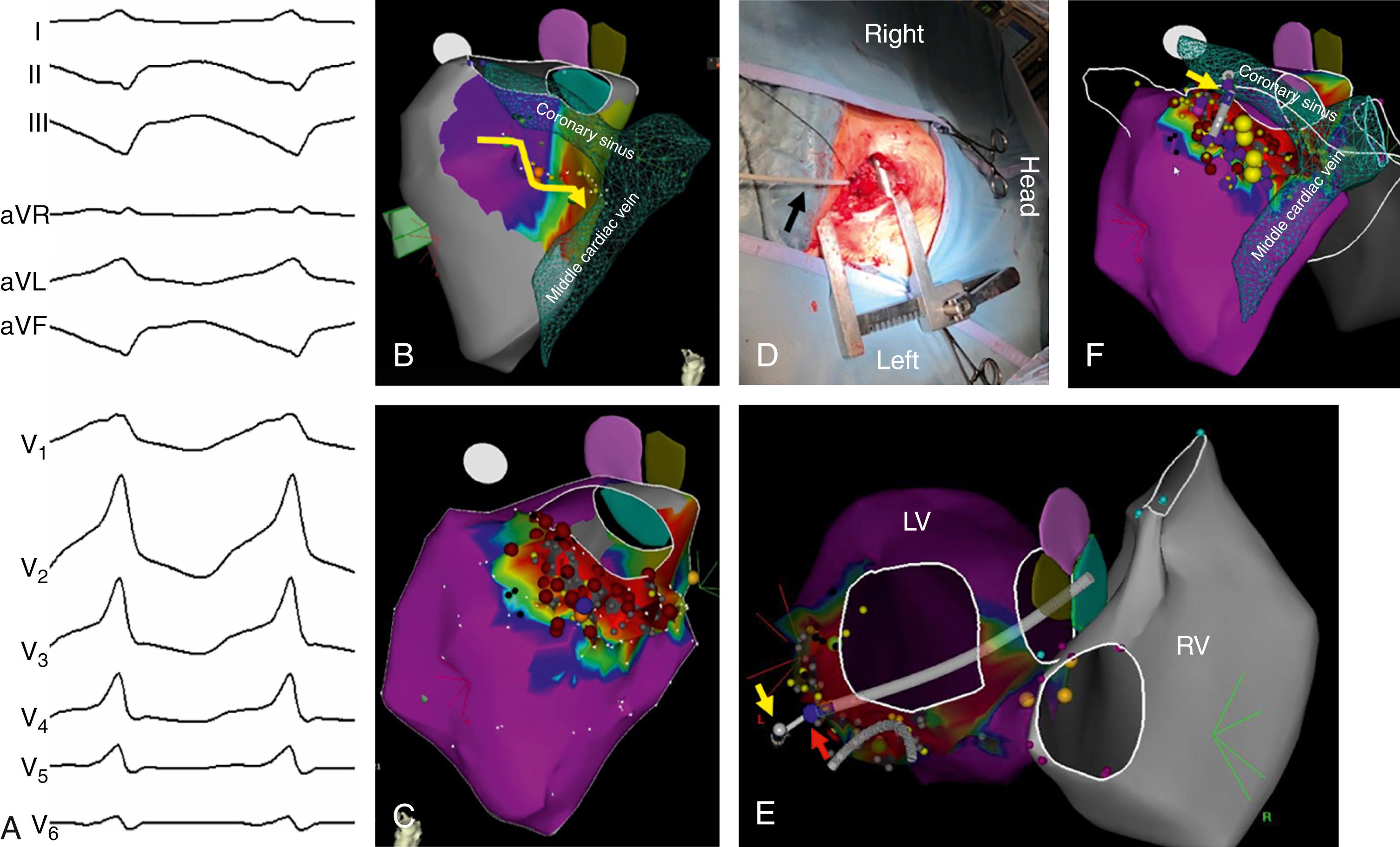 Fig. 136.4, Examples of surgical ventricular tachycardia (VT) ablation performed using epicardial access via apical thoracotomy in a patient with a prior history of mitral valve repair.