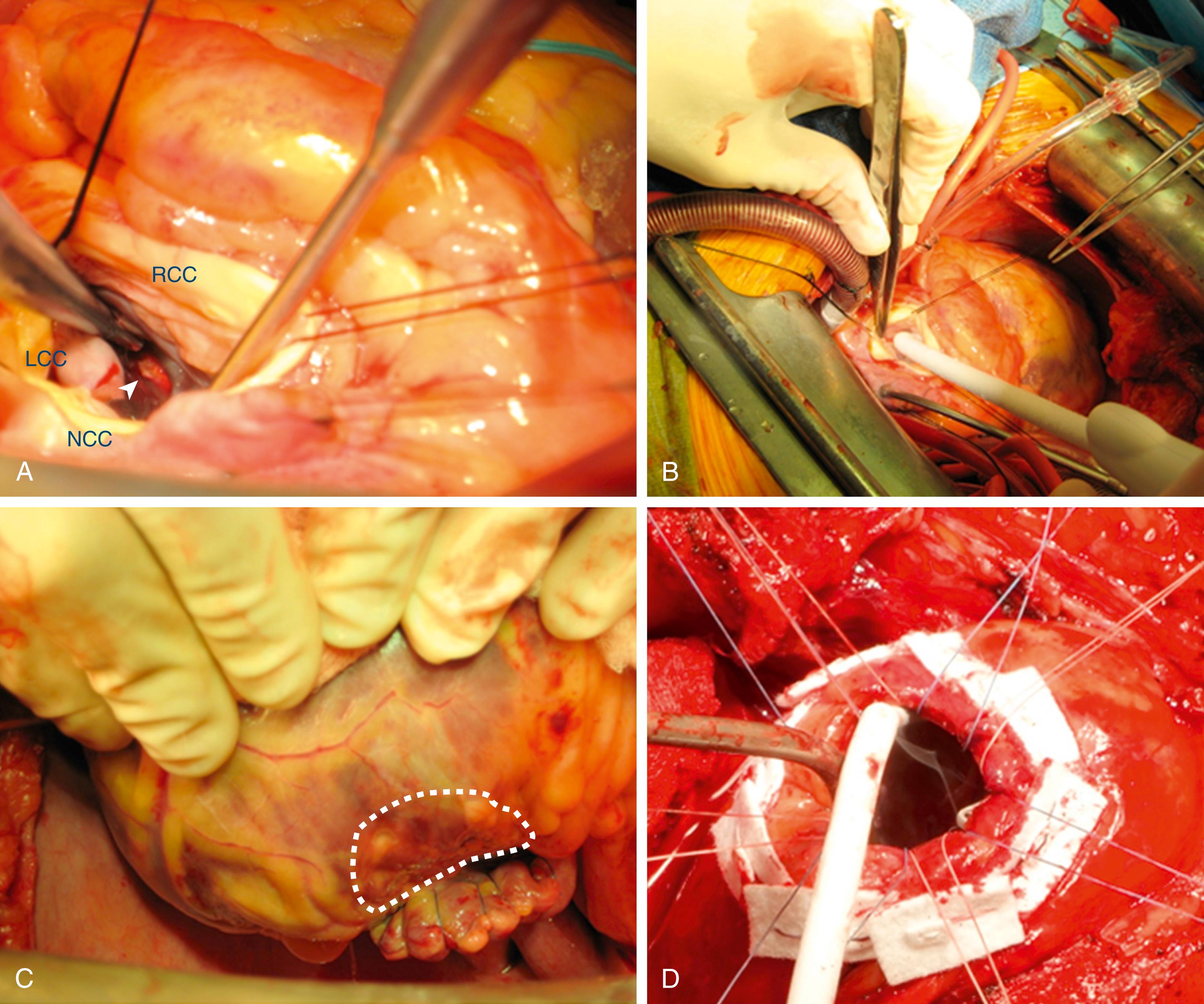 Fig. 136.6, Our approach to surgical ventricular tachycardia ablation by cryothermy.