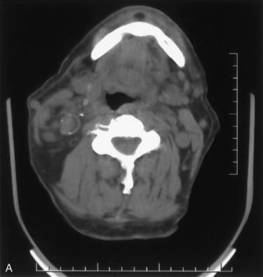 Fig. 6.1, Patient with a large cervical and substernal goiter. Substernal goiter extends into the left chest and then crosses retrotracheally into the right chest, extending between the trachea and esophagus (substernal goiter type IIB2). A, Right superior pole extends beneath the sternocleidomastoid muscle to the level of the mandible. B, At the level of the cricoid cartilage, goiter is present bilaterally in the neck. C, At the level of the thoracic inlet, the left lobe expands and extends into the left chest and retrotracheally into the right thorax. D, The mass extends substernally along the left lateral trachea and retrotracheally, abutting both left and right lung fields, splaying the great vessels. E, The distal segment of the substernal mass has several lobulations. The innominate artery is seen anterior to the trachea. A bronchus abuts the lateral aspect of the inferior-most goiter segment. The goiter posteriorly abuts the vertebral column. F, The inferior-most extent of the goiter extends retrotracheally deep to the level of the aortic arch. The mass can be seen infiltrating the region between the trachea anteriorly and the esophagus posteriorly. G, The mass extends between the trachea and esophagus, ending just above the azygous vein and right mainstem bronchus. H, Barium swallow showing substantial cervical and mediastinal esophageal deviation. The mass was resected transcervically without sternotomy, with recurrent laryngeal nerve and vagal monitoring with normal cord motion postoperatively. The specimen weighed 450 g and was 15 cm in greatest diameter.