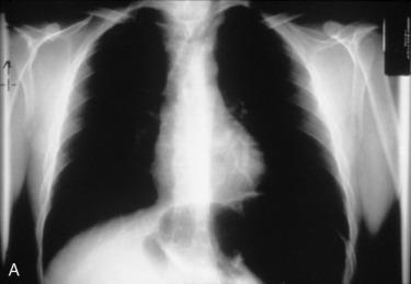 Fig. 6.2, A, A patient with hemorrhage within a benign follicular adenoma with sudden enlargement and sudden onset airway deviation and compression with respiratory symptoms. Note that the tracheal air column is substantially deviated to the left and that on plain chest radiograph, no significant compression is appreciated. B, Magnetic resonance imaging axial scanning shows substantial airway compression. Note the density within the center of the thyroid mass that represents hemorrhage.