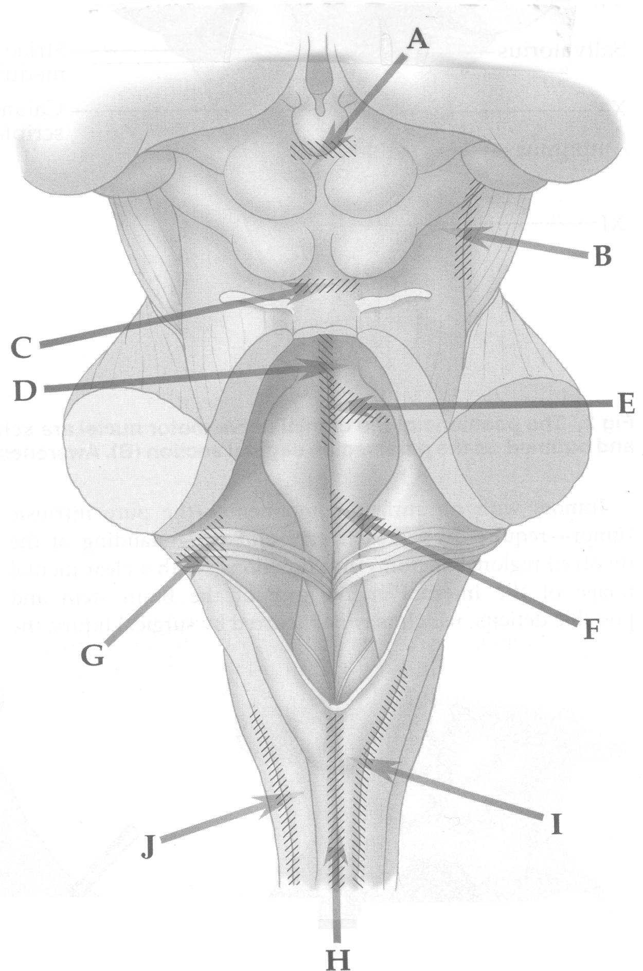 Figure 22.2, Relatively safe entry zones into the dorsal brain stem. Supracollicular (A), infracollicular (C), and lateral mesencephalic sulcus (B) are suitable entries for the removal of tectal mesencephalic tumors approached by the infratentorial–supracerebellar route. The median sulcus above the facial colliculus (D), suprafacial (E), infrafacial (F), and area acoustica (G) provides safe entry for dorsal pontine tumors approached through the floor of the fourth ventricle. The posterior median fissure below the obex (H), the posterior intermediate sulcus (I), and the posterior lateral sulcus (J) are sites recommended for longitudinal myelotomies to approach medullary and cervicomedullary junction tumors.