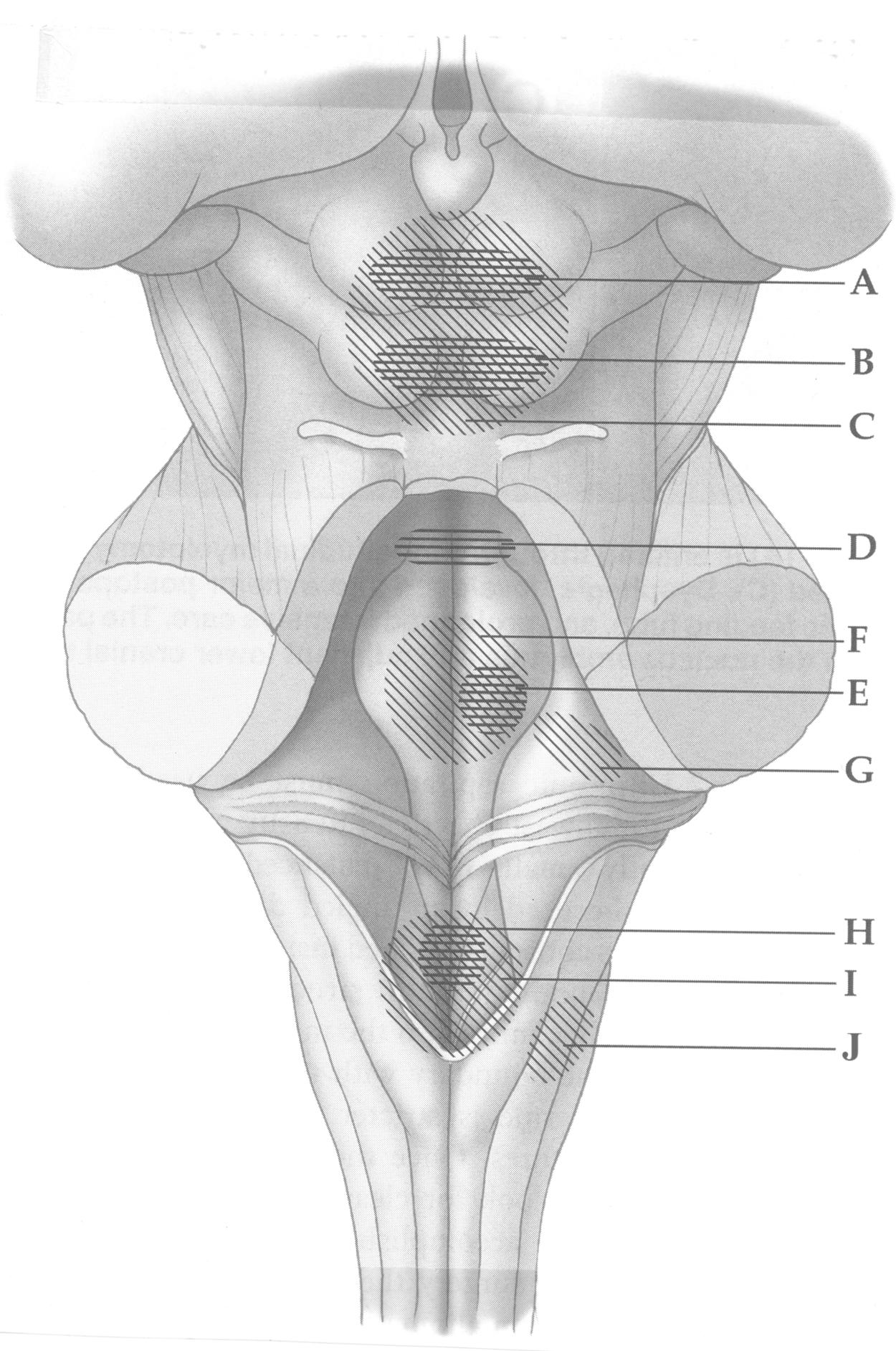 Figure 22.3, Outline of the dangerous areas for entering the dorsal brain stem. Superior colliculus (associated with visual and oculomotor disorders) (A), inferior colliculus (auditory disturbances) (B), corpora quadrigemina (C) (as in A and B), medial longitudinal fascicles (internuclear ophtalmoplegia) (D), facial colliculus (facial palsy and internuclear ophtalmoplegia) (E), facial colliculus (immobile eyes and bilateral facial palsy) (F), facial nerve (facial palsy) (G), hypoglossal and vagus nuclei (dysphagia) (H), calamus scriptorius (dysphagia and cardiorespiratory disturbances) (I), and gracilis and cuneate tubercles (ataxia) (J).