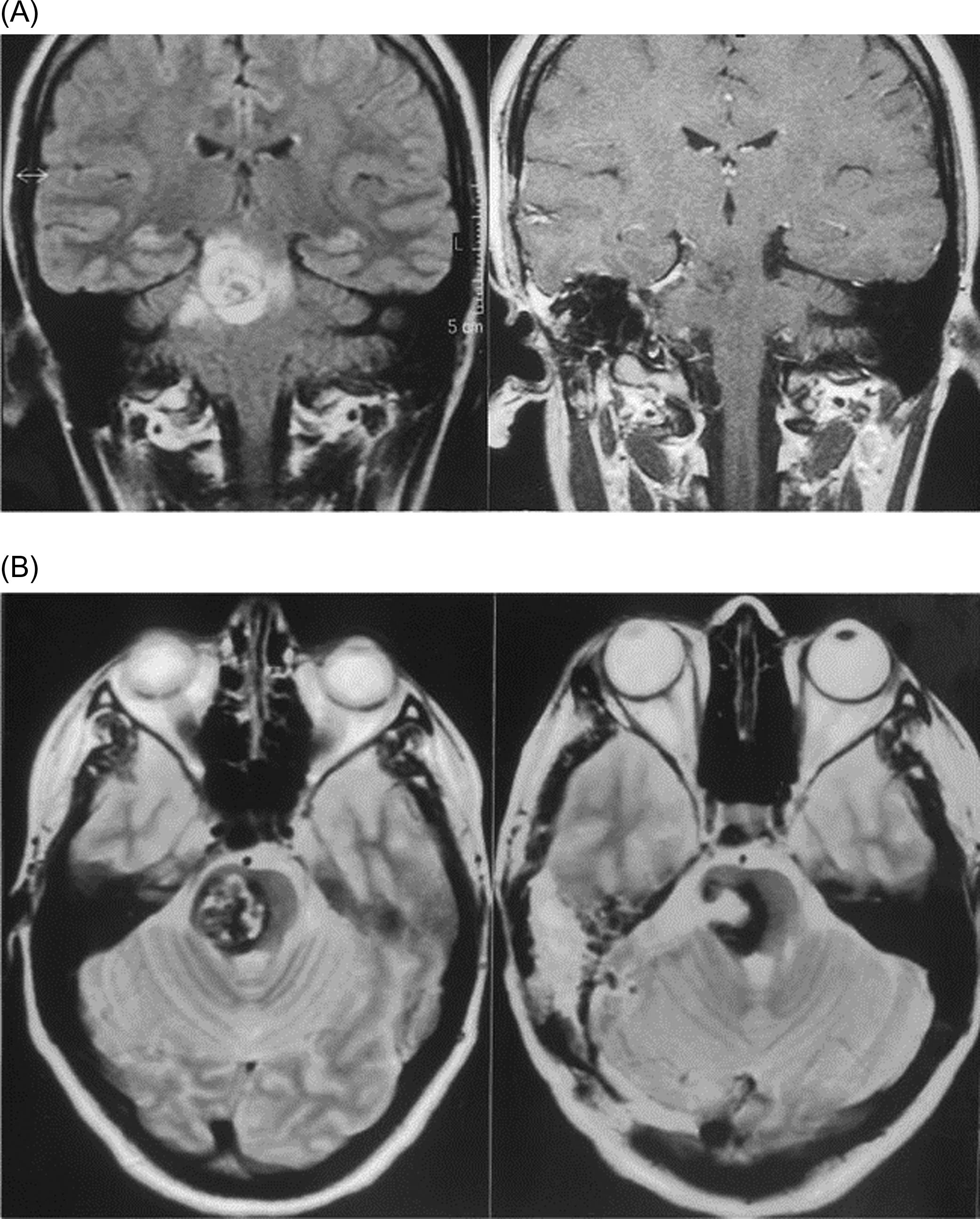 Figure 22.4, Large cavernous malformation in the pons removed through a posterolateral transpetrosal approach. Pre- and postoperative coronal (A) and axial (B) MRIs. Note, in the early T2 postoperative axial images, the route followed for removal.