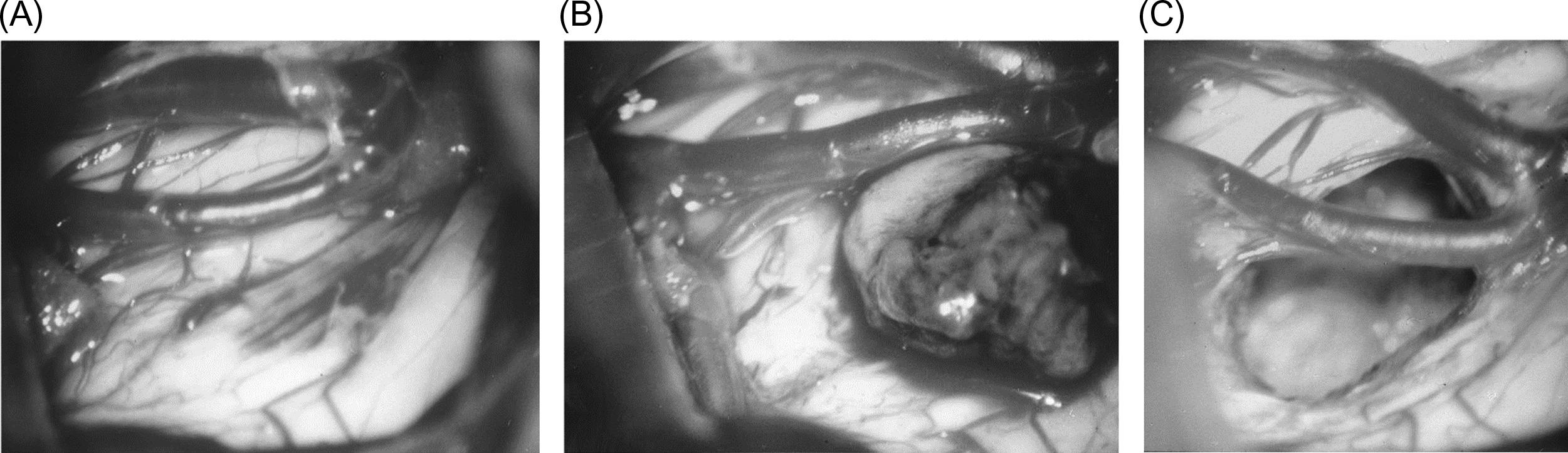 Figure 22.5, Intraoperative microphotographs of the patient in Fig. 22.4 . The right lateral aspect of the pons encircled by the superior cerebellar artery and the trigeminal root is directly exposed (A) and entered. The cavernoma is easily removed without any surgical injury to the neurovascular structures involved (B and C).