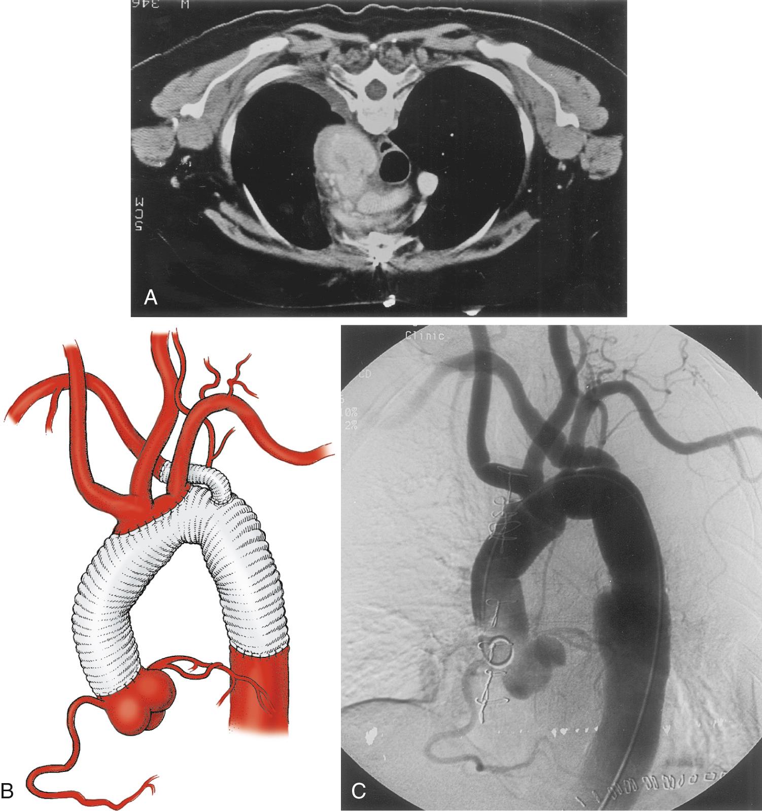 FIGURE 68-1, A, Computed tomography scan of an aortic arch aneurysm associated with an aberrant right subclavian artery that was treated by a modified elephant trunk technique. B, The first stage of the elephant trunk procedure was done with an anastomosis between the left subclavian artery and the aberrant right subclavian artery, and the second stage was performed with an interposition graft to the right subclavian artery. C, Angiogram of the completed repair. Note the tube graft to the right subclavian artery arising from the more distal part of the aortic arch.