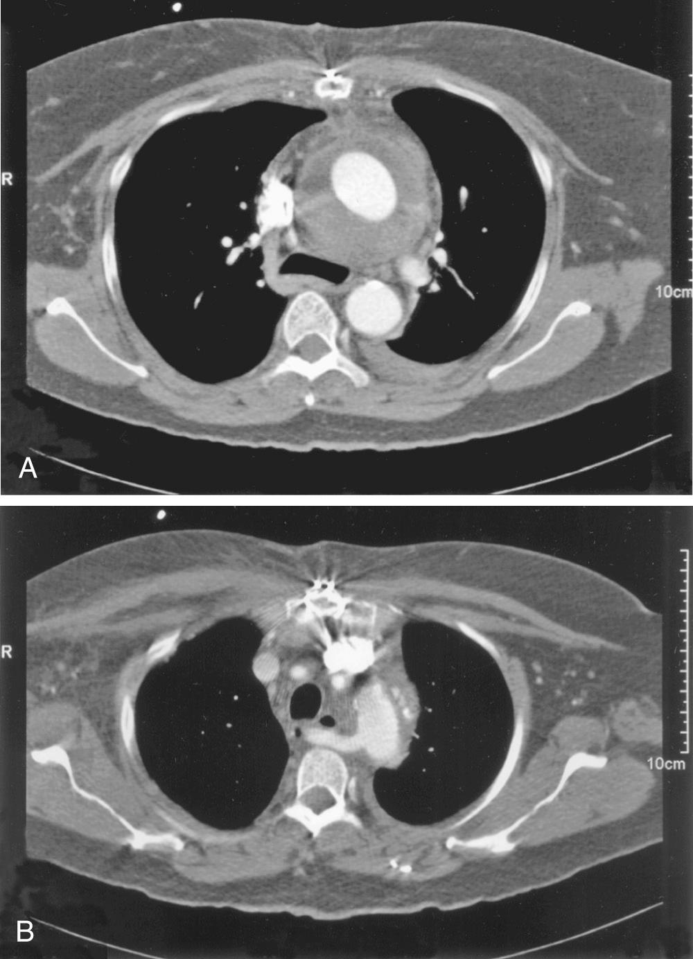 FIGURE 68-2, A, Computed tomography (CT) scan from a patient with an ascending and arch aneurysm, with extensive clot formation in the aneurysm, associated with an aberrant right subclavian artery. B, CT scan after the repair. The repair was done from the aberrant right subclavian artery ostium, through the aortic arch, using a long “tongue” extension into the descending aorta. The ascending aorta was replaced with a composite valve graft. Note the aberrant right subclavian artery coming off the distal aorta and running posterior to the esophagus and trachea.