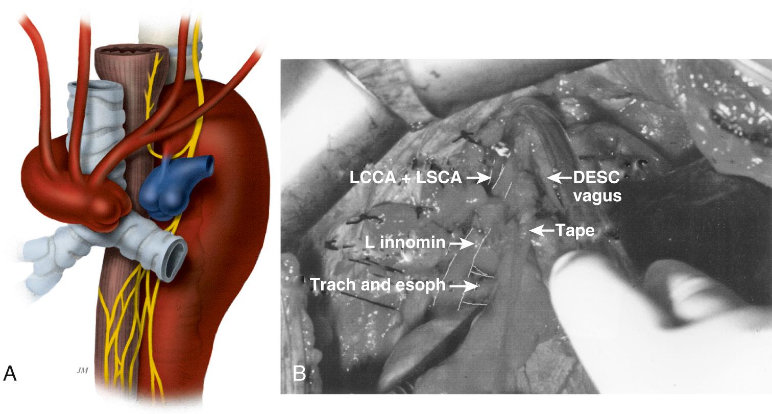 FIGURE 68-3, A, Illustration of right-sided aortic arch with vascular ring. B, Intraoperative findings. DESC, Descending aorta; esoph, esophagus; L innomin, left innominate artery; LCAA, left common carotid artery; LSCA, left subclavian artery; trach, trachea.