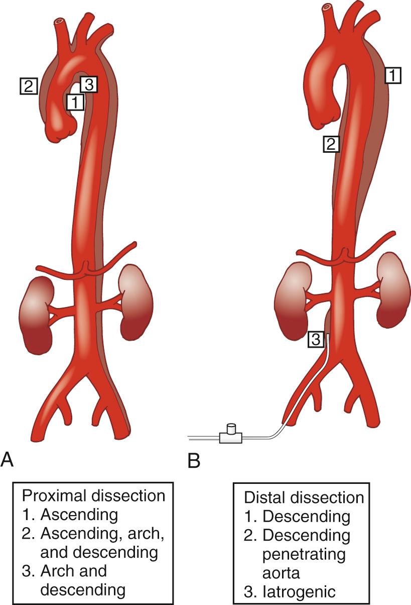 FIGURE 68-5, Aortic dissection classification. A, Proximal dissection: (1) involvement of the ascending aorta only; (2) ascending, aortic arch, and descending aorta involvement; and (3) arch and descending involvement. B, Distal dissection: (1) involvement of the descending aorta with or without the abdominal aorta; (2) penetrating aortic ulcer with descending dissection; and (3) abdominal dissection (usually iatrogenic).