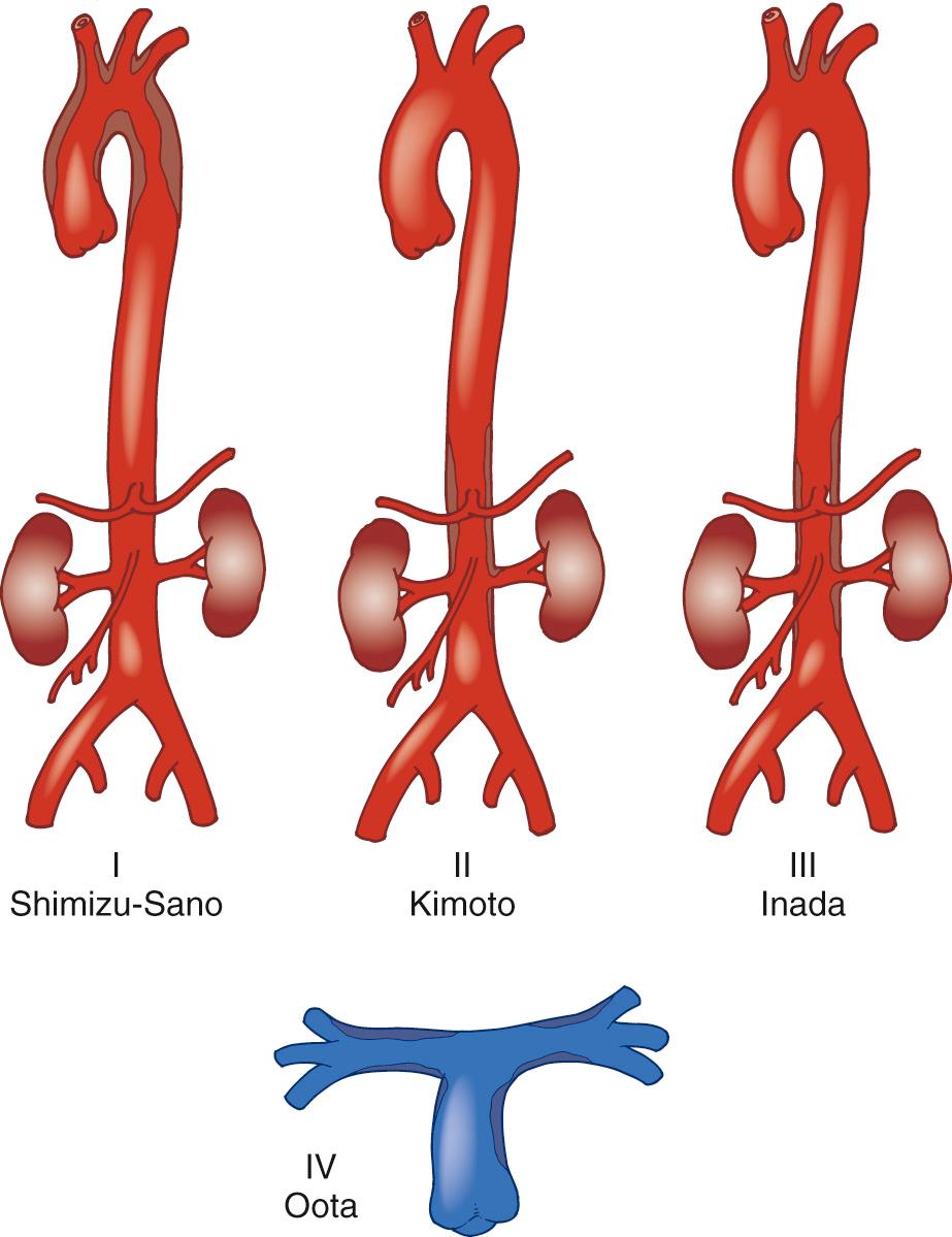 FIGURE 68-6, Classification of Takayasu aortitis. Subtypes and their extents are depicted.