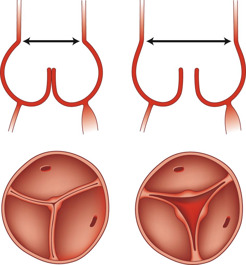 FIGURE 67-4, Dilation of the sinotubular junction causes aortic insufficiency.