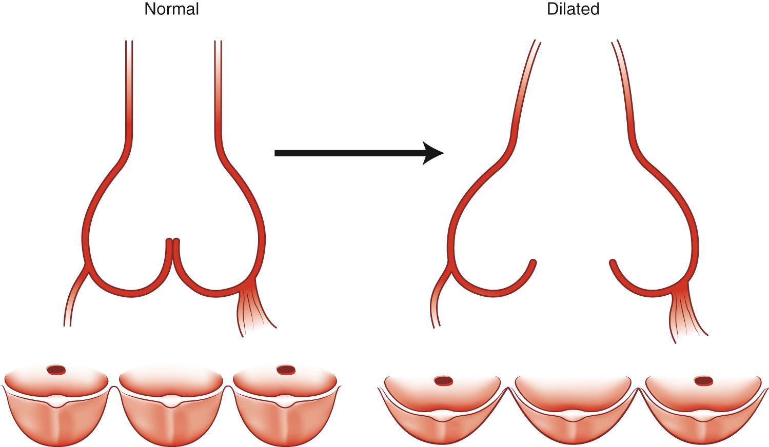 FIGURE 67-6, Dilation of the aortic annulus. The subcommissural triangles of the noncoronary cusp become more obtuse.