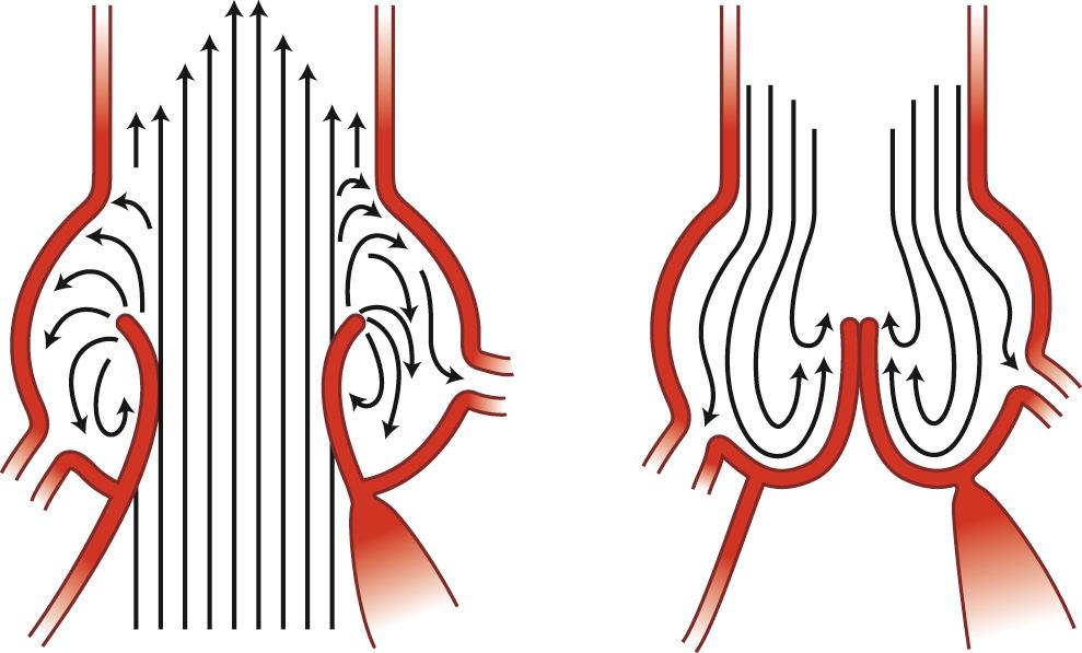 FIGURE 67-7, The aortic sinuses create eddies and currents and facilitate aortic valve closure.