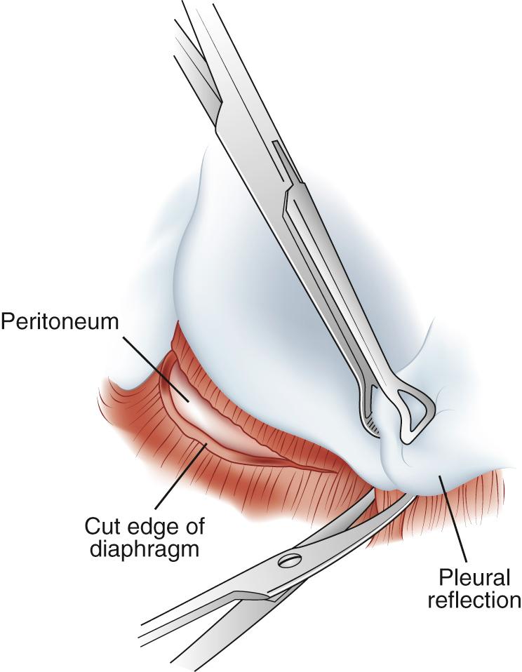 FIGURE 32-3, The parietal pleura folds off the rib cage and onto the diaphragm but does not extend into the deep recess of the diaphragmatic sulcus. A bare area of diaphragmatic muscle can be exposed with traction on the parietal pleura.