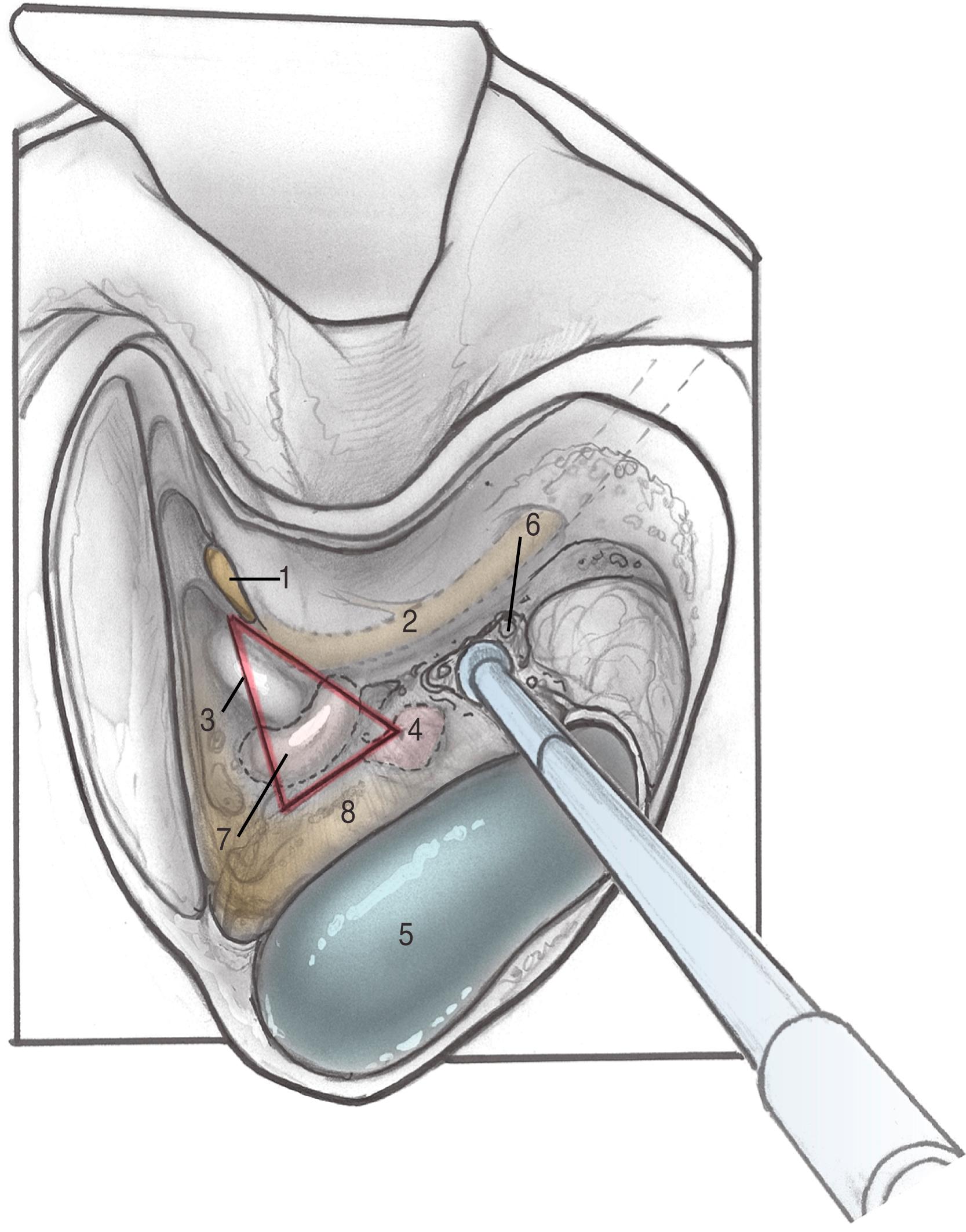 Fig. 32.1, Completed mastoidectomy showing the head of the incus (1), second genu of facial nerve (2), horizontal semicircular canal and plane of Donaldson’s line and triangle outlining the hard angle (3), position of endolymphatic sac (4), sigmoid sinus (5), retrofacial air cell tract (6), posterior semicircular canal (7), and posterior fossa dural plate (8).