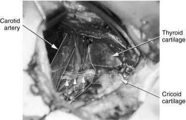 Fig. 36.5, Right lateral thyroid bed region showing the nonrecurrent right recurrent laryngeal nerve (RLN). Three small white arrows point to bifid nonrecurrent right RLN emerging from behind the carotid artery (laterally, outlined in white dots) and extending to the larynx. The thyroid and cricoid cartilages and trachea (medially) are outlined in white dots.