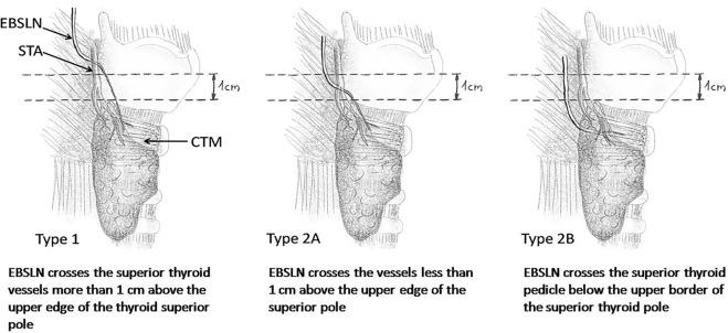 Fig. 35.3, Cernea’s external branch of the superior laryngeal nerve (EBSLN) surgical anatomic classification scheme.