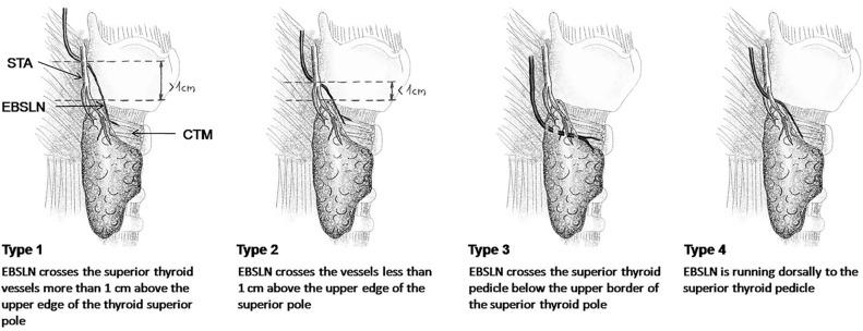 Fig. 35.4, Kierner external branch of the superior laryngeal nerve (EBSLN) surgical anatomic classification scheme.