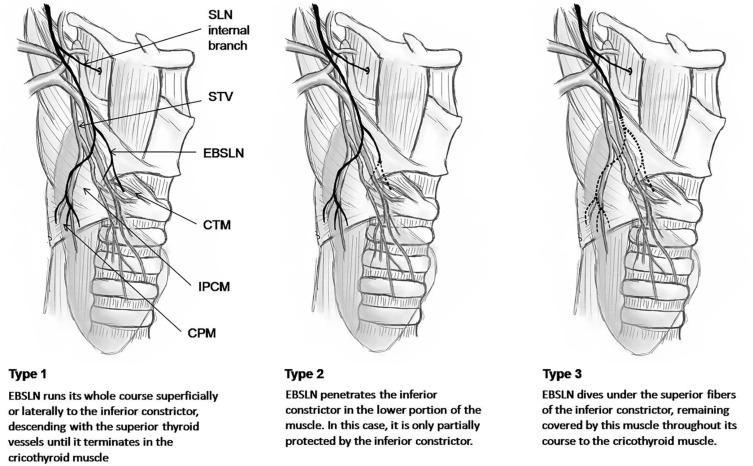 Fig. 35.5, Friedman external branch of the superior laryngeal nerve (EBSLN) surgical anatomic classification scheme. CPM cricopharyngeus muscle, IPCM inferior constrictor muscle, STV superior thyroid vien