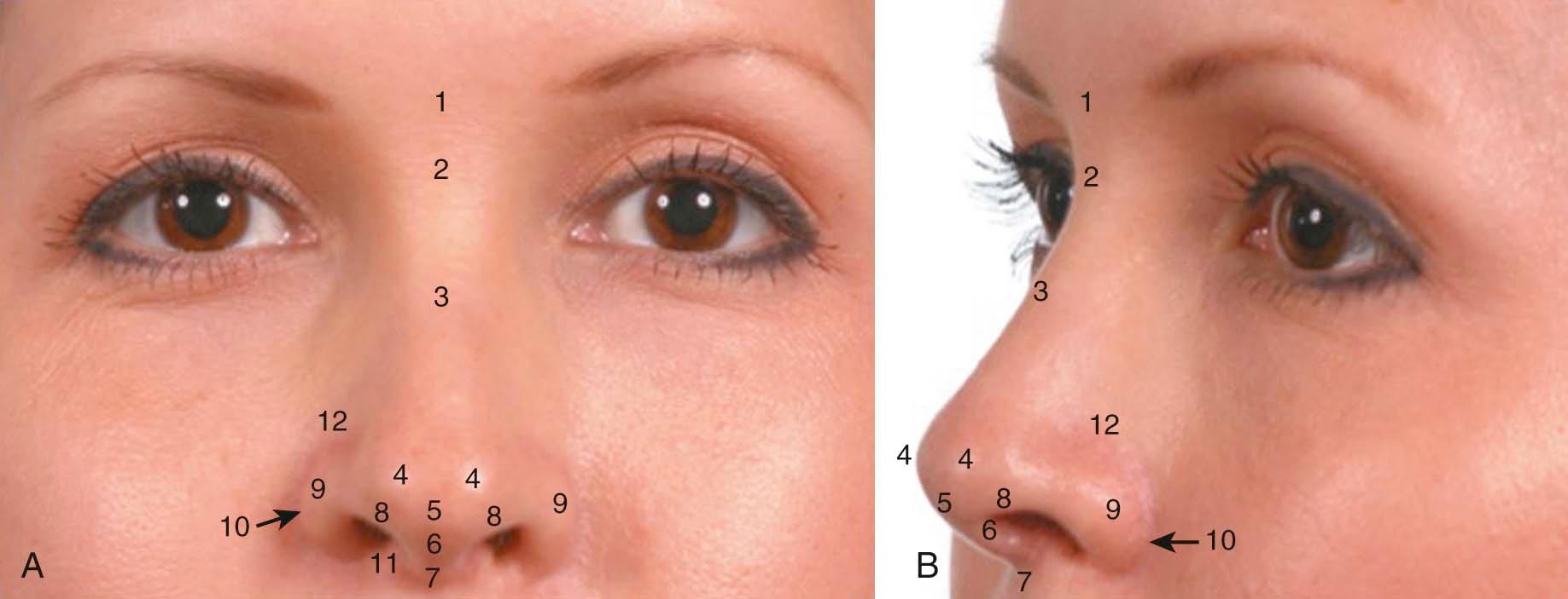 Figure 2-2, Topographic key landmarks on ( A ) frontal and ( B ) oblique views of the nose. 1, Glabella; 2, nasion; 3, rhinion; 4, tip-defining points; 5, infratip lobule; 6, columella; 7, nasolabial angle; 8, soft tissue triangles (facets); 9 , alar lobules; 10, alar–facial groove; 11, nasal sill; 12, supraalar crease.