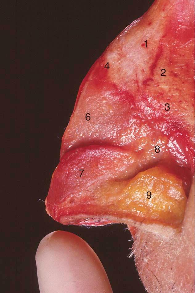 Figure 2-4, Cadaveric dissection demonstrating principal components of the nasal anatomy. 1, Nasal bones; 2 , nasomaxillary suture line; 3 , ascending process of the maxilla; 4 , osteocartilaginous junction (rhinion); 5 , anterior septal angle; 6 , upper lateral cartilage (ULC); 7 , lateral crus of the lower lateral cartilage (LLC); 8 , sesamoid cartilage; 9 , alar lobule (fibrofatty tissue).