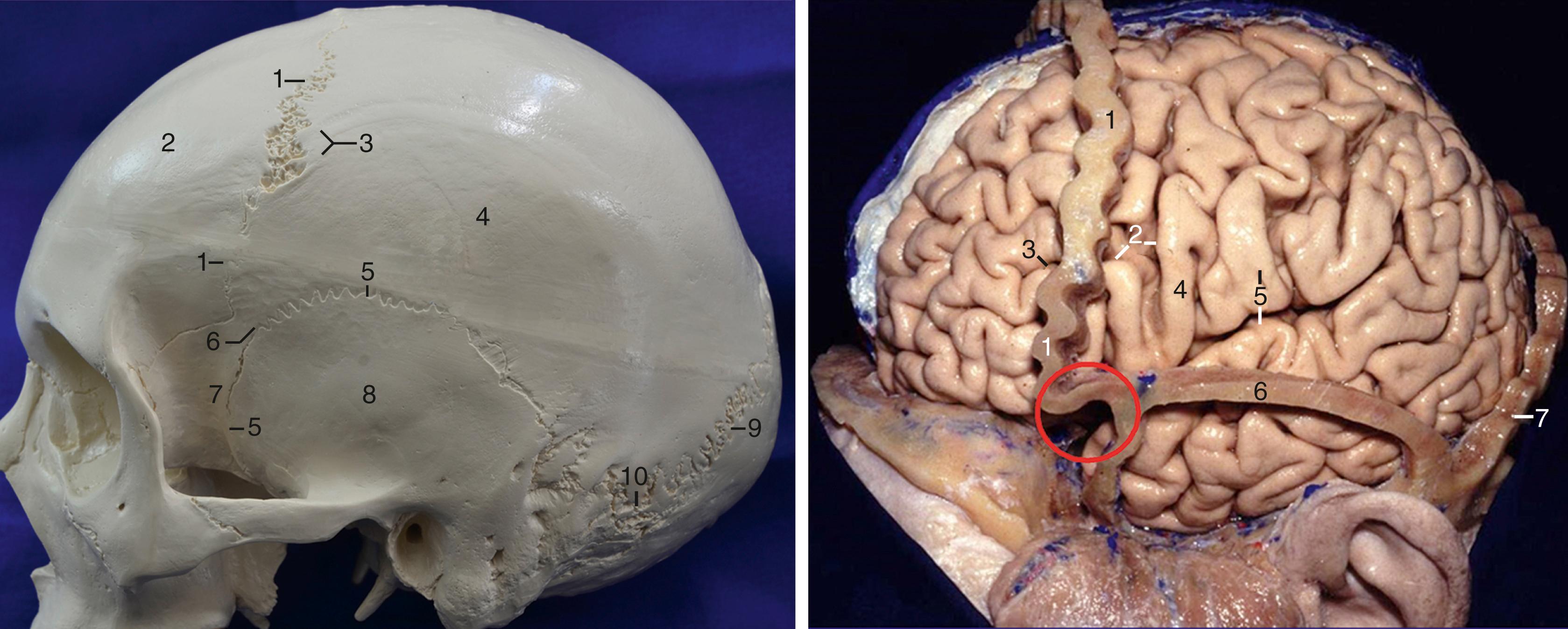 eFigure 2.3., Left, Lateral view of the left side of a human skull. 1, Coronal suture; 2, frontal bone; 3, superior temporal line; 4, parietal bone; 5, squamous suture; 6, pterion; 7, sphenoid bone; 8, squamous part of the temporal bone; 9, lambdoid suture; 10, asterion (meeting point of the lambdoid, occipitomastoid, and parietomastoid sutures). Right, Lateral view of the left cerebral hemisphere; the coronal, squamous, and lambdoid sutures have been left in place. 1, Coronal suture; 2, precentral and inferior frontal sulci; 3, inferior frontal sulcus; 4, precentral gyrus; 5, postcentral gyrus and the posterior ramus of the sylvian fissure; 6, squamous suture; 7, lambdoid suture. The red circle indicates the pterion region.